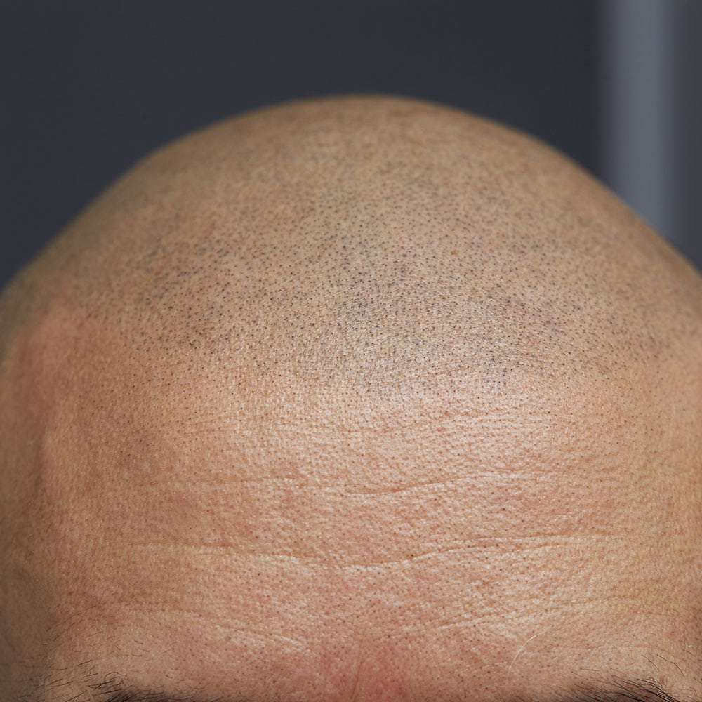 13: carolina scalp center