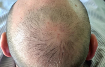 Hair transplant scars including strip and fue types improved with scalp micropigmentation